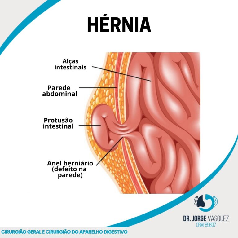 Hérnia Femoral x Inguinal: quais as diferenças? - SBH